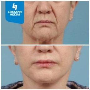 before-after photo mini-facelift