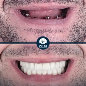 before-after photo all-on-4-dental-implants