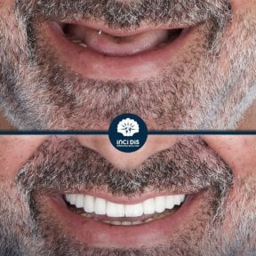 before-after photo all-on-4-dental-implants