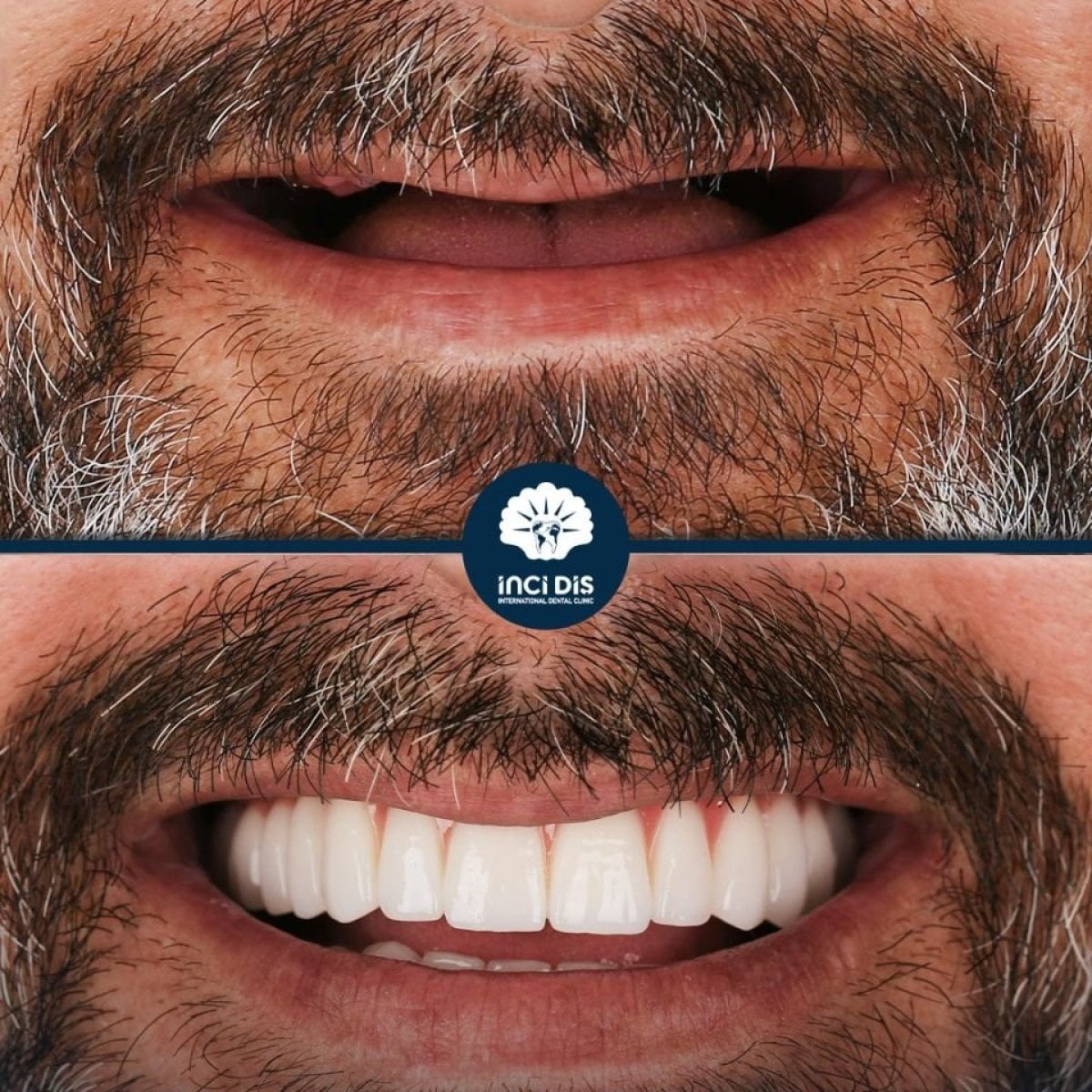 نتيجة قبل وبعد زراعة الأسنان All-on-4 في عيادة Inci Dis International Dental Clinic