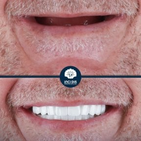before-after photo all-on-4-dental-implants