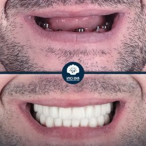 before-after photo dental-implant