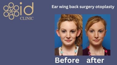 before-after photo rhinoplasty-nose-job