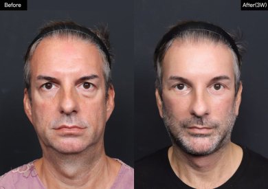 Результати до і після deep plane SMAS-ліфтингу у VG Plastic Surgery, омолодження обличчя