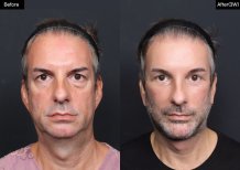 Результати до і після deep plane SMAS-ліфтингу у VG Plastic Surgery, омолодження обличчя