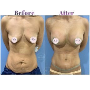Resultados antes y después de aumento de senos y abdominoplastia en Db'est Clinic
