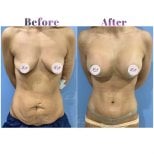 Resultados antes y después de aumento de senos y abdominoplastia en Db'est Clinic