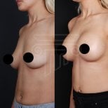 Before and after breast implants with lift results at Dr. Safa Manav Clinic, enhanced contour