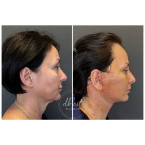 Résultats lifting visage avant/après à Db'est Clinic, amélioration du contour facial