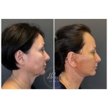 Résultats lifting visage avant/après à Db'est Clinic, amélioration du contour facial