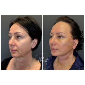 Résultats avant et après lifting du visage à Db'est Clinic, rajeunissement visible