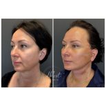 Résultats avant et après lifting du visage à Db'est Clinic, rajeunissement visible