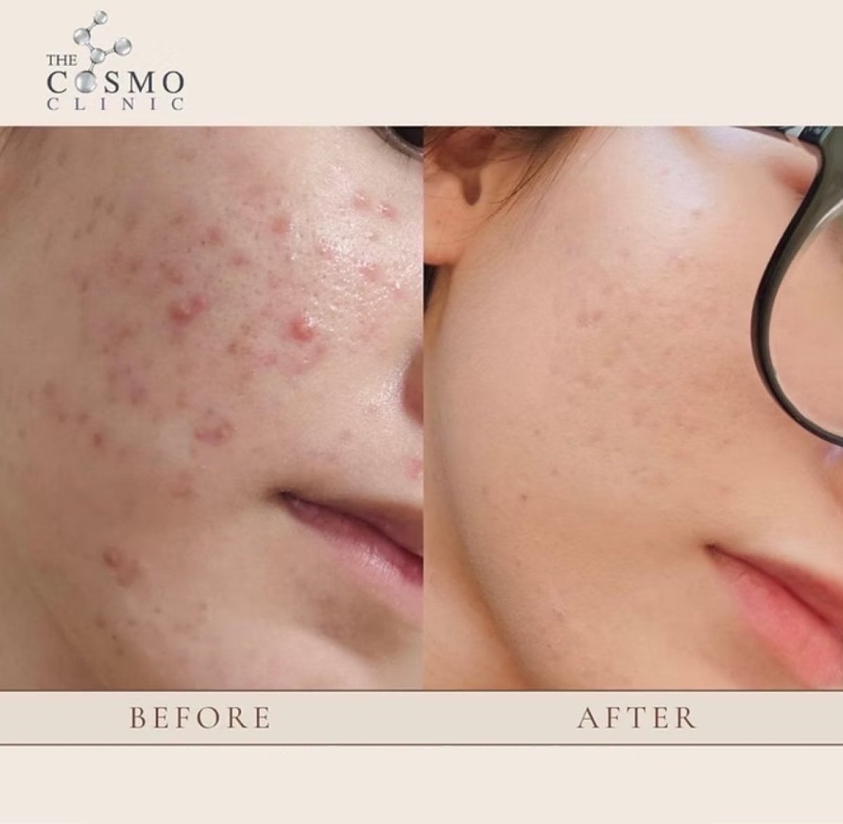 نتائج علاج ندبات حب الشباب في The Cosmo Clinic – تحسن ملموس في ملمس البشرة