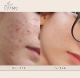 Before and after acne scar treatment at The Cosmo Clinic – visible skin texture improvement result