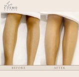 Before and after laser hair removal results on legs at The Cosmo Clinic, smoother skin visible
