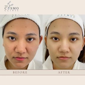 Before and after Morpheus8 skin tightening results at The Cosmo Clinic, smoother facial skin