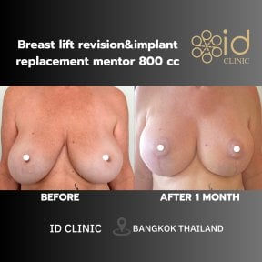 before-after photo breast-augmentation