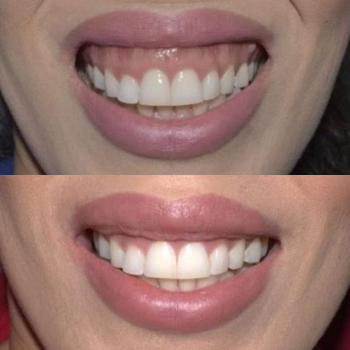 نتائج قبل وبعد جينجيفيكتومي في SoftDentalCare Clinic، تحسين خط اللثة والابتسامة