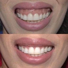 Before and after gingivectomy results at SoftDentalCare Clinic, improved gum line and smile