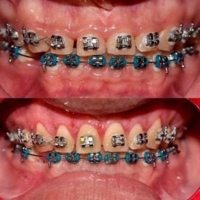 Before and after gingivectomy results with braces at SoftDentalCare Clinic, improved gum line