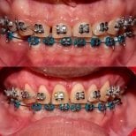 Before and after gingivectomy results with braces at SoftDentalCare Clinic, improved gum line