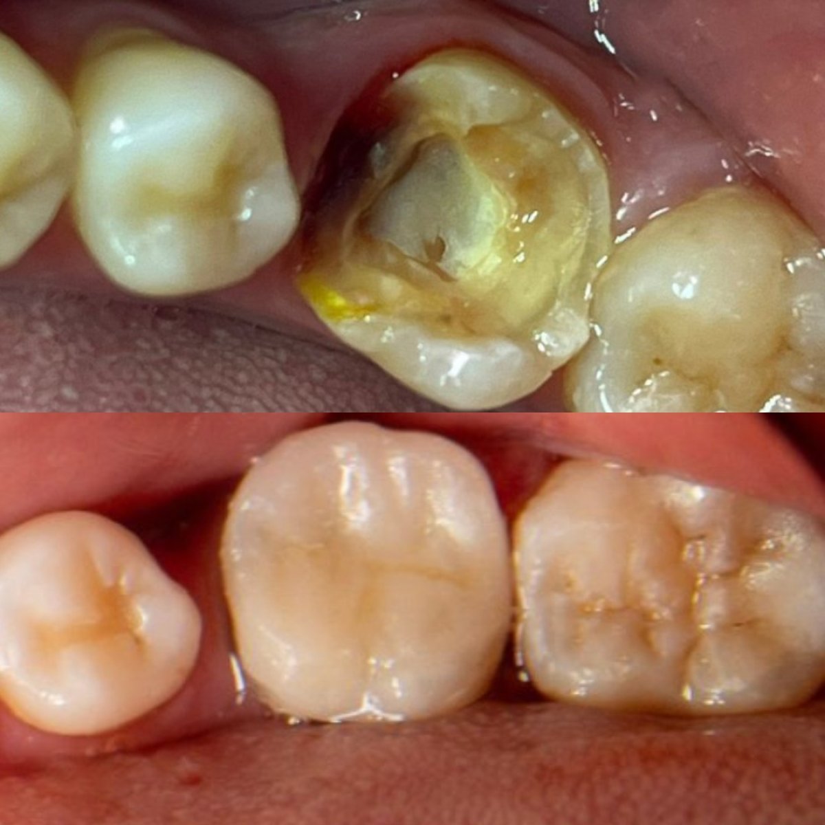 Antes y después de restauración inlay/onlay en Dr. Cristhian Figueroa — resultado visible