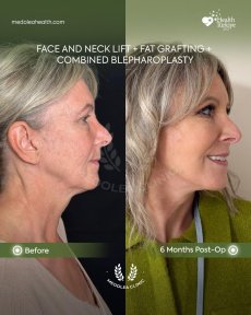 before-after photo deep-plane-facelift