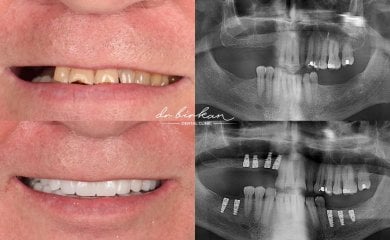 before-after photo implantacia-zuba