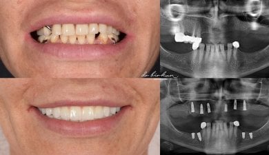 before-after photo implantacia-zuba