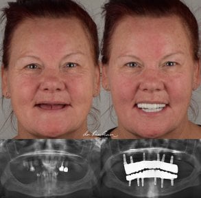 before-after photo protezirovanie-zubov