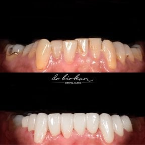 before-after photo protezirovanie-zubov