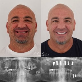 before-after photo protezirovanie-zubov