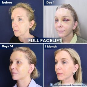 Full facelift before and after results at Intrarat Hospital – visible facial rejuvenation