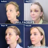 Full facelift before and after results at Intrarat Hospital – visible facial rejuvenation