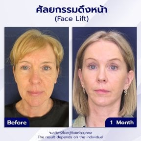 before-after photo deep-plane-facelift