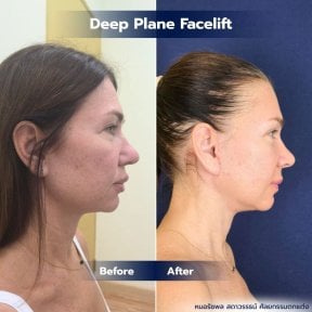 before-after photo deep-plane-facelift