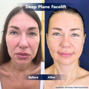 Before and after deep plane facelift results at Intrarat Hospital, facial rejuvenation outcome