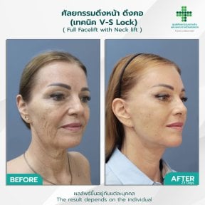 before-after photo deep-plane-facelift