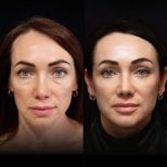 Résultats avant/après blépharoplastie des paupières inférieures à Vidnova Clinic, poches réduites