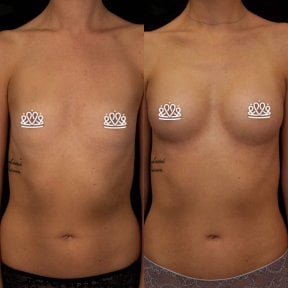 before-after photo mammoplasty