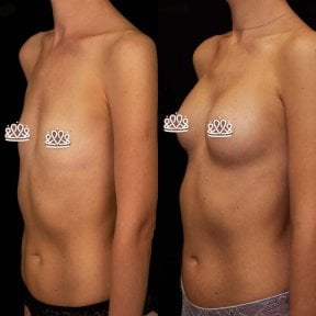 before-after photo mammoplasty