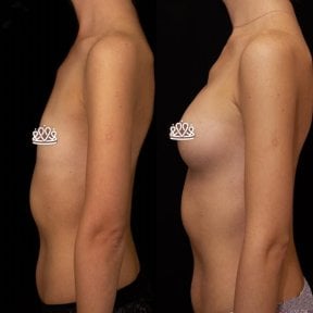 before-after photo mammoplasty