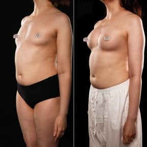 before-after photo mammoplasty