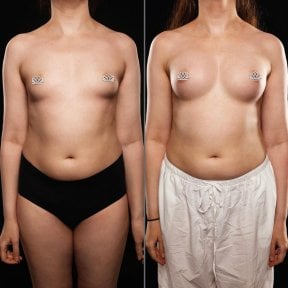 before-after photo mammoplasty