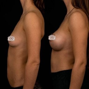 before-after photo mammoplasty
