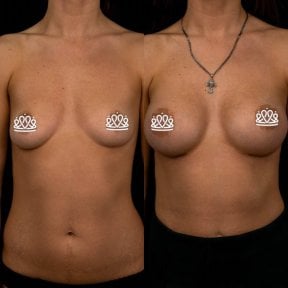 before-after photo mammoplasty