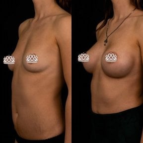 before-after photo mammoplasty