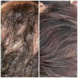 Resultados de trasplante capilar antes y después en Dr. Sevgi Ekiyor – cabello más denso