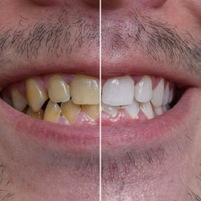 before-after photo tooth-whitening