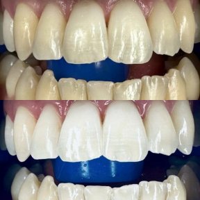 before-after photo tooth-whitening